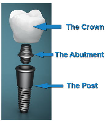 post-crown-abutment2