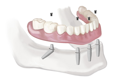 teeth-in-a-day